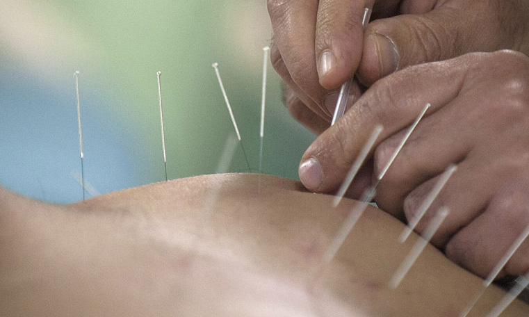 Acupuncture For TMJ